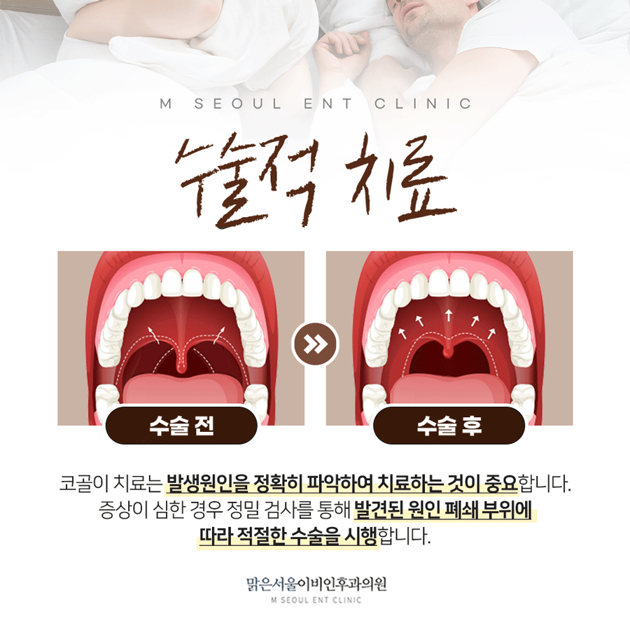 의정부수면무호흡증 맑은서울이비인후과에서