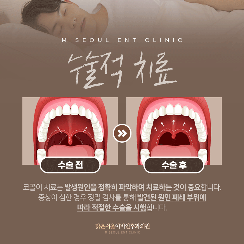 동두천코골이 지속된다면