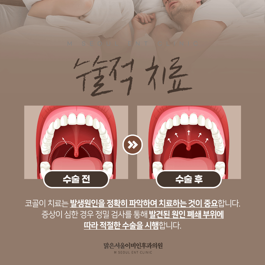 동두천수면무호흡증 자는 동안 일어나는