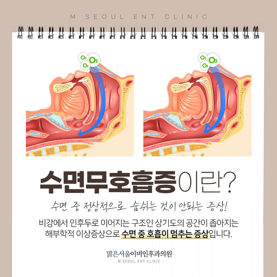 남양주코골이 수면의 질을 떨어뜨리는