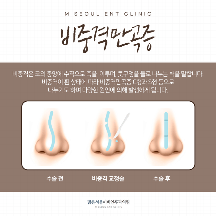 의정부비중격만곡증 심한 코막힘에