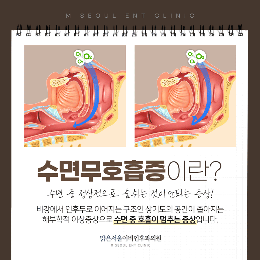 신곡동이비인후과 코골이 고민에