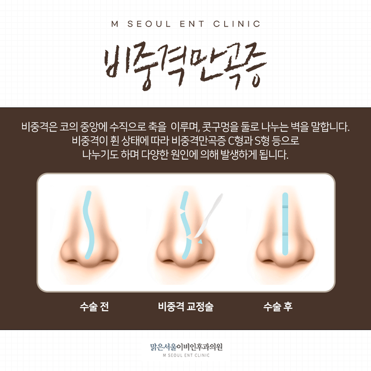상계동이비인후과 신중한 선택을