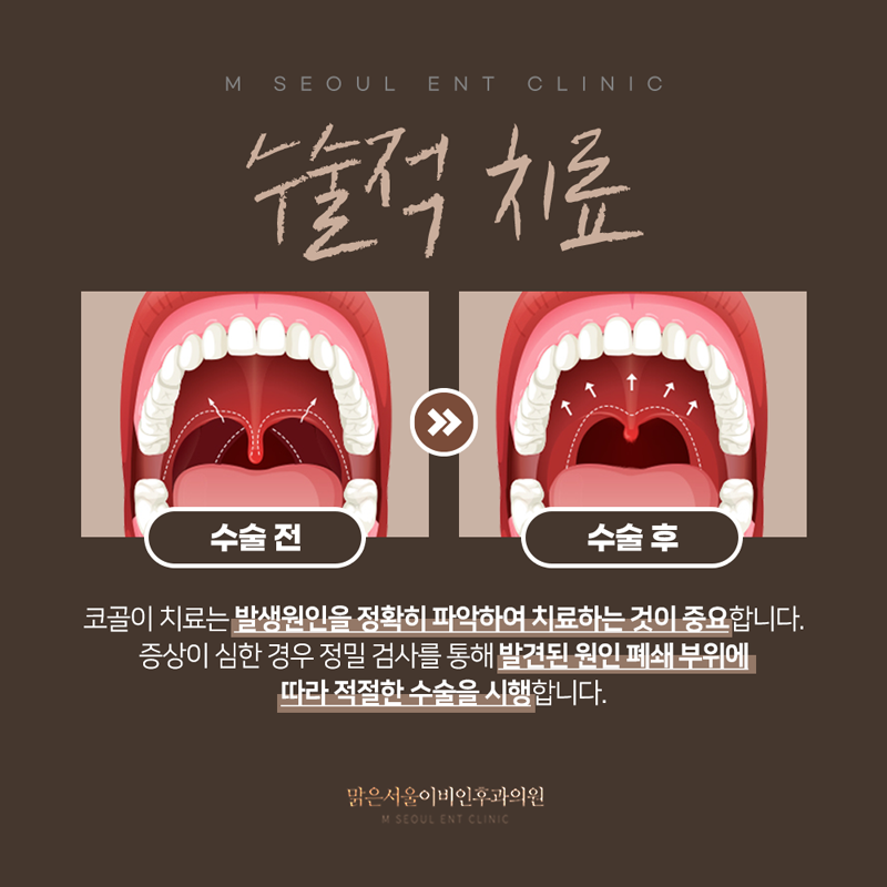의정부이비인후과추천 코골이 고민에