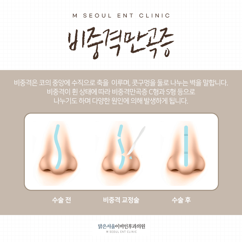 남양주비중격만곡증 어떤 증상이