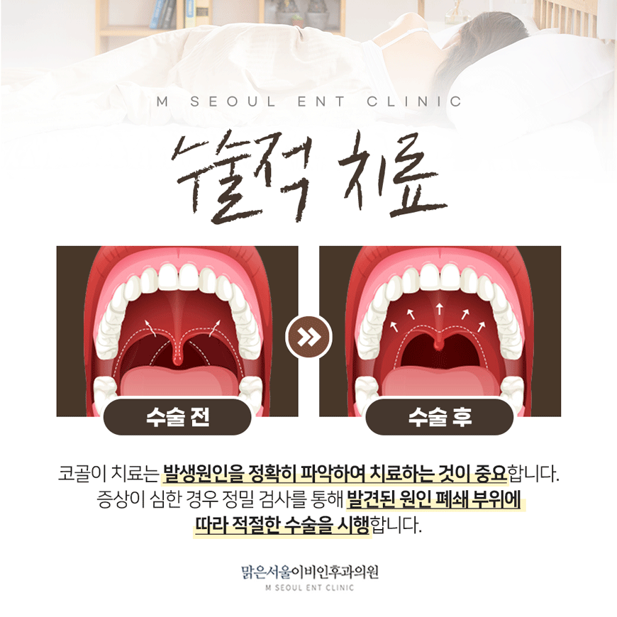 양주코골이 올바른 치료를