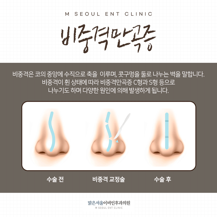 비중격만곡증치료 어려웠다면