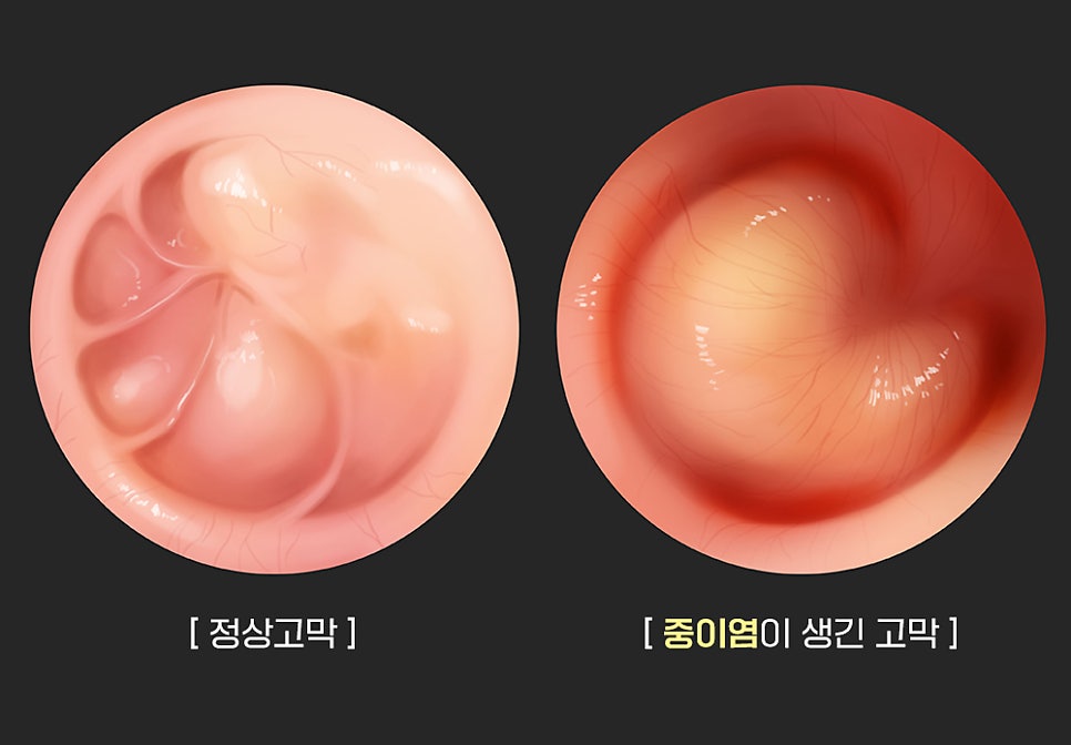 구리이비인후과, 갑작스러운 이명현상과 어지러움! 중이염 의심해봐야