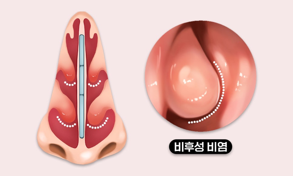 의정부 비후성 비염 치료방법은? 자세히 알아봐요.