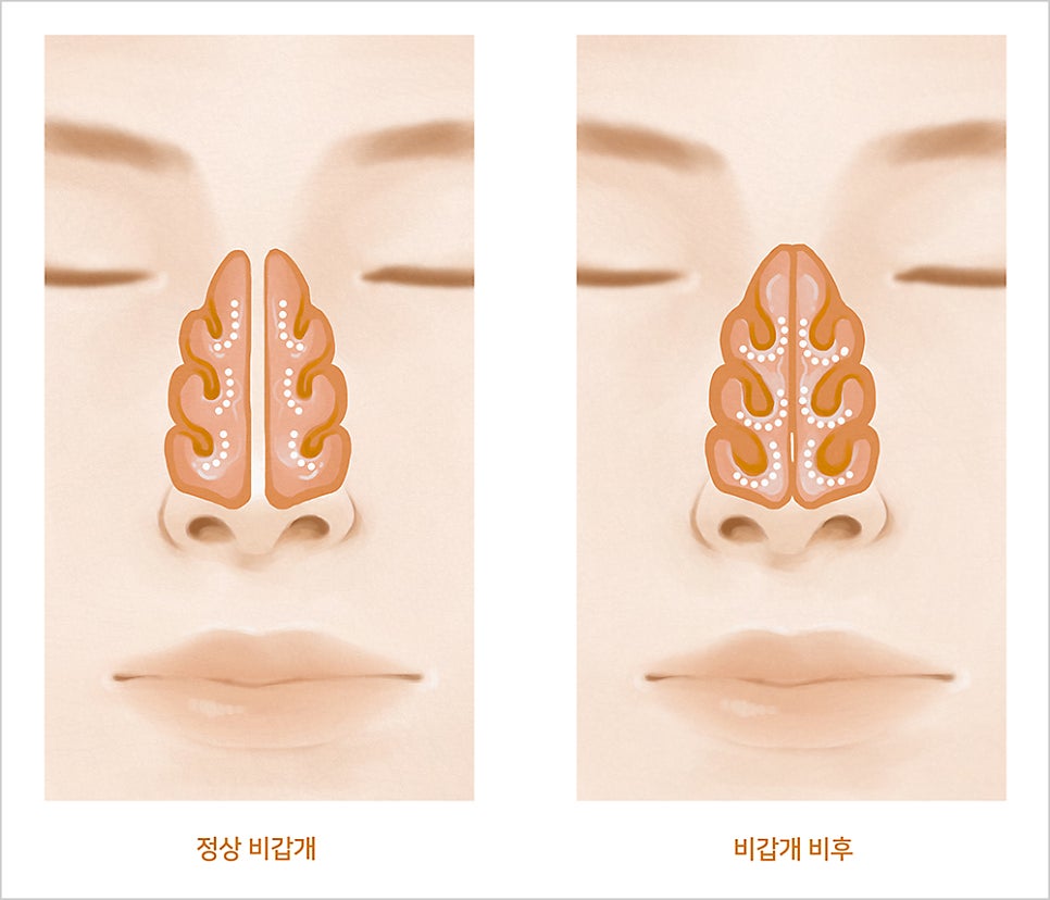 민락동이비인후과 하비갑개절제술 신중하게 결정하세요!