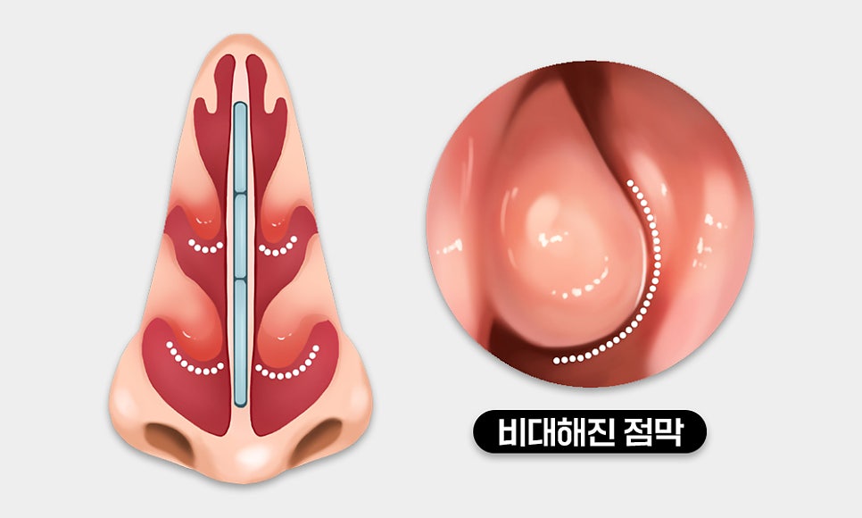 선천성vs후천성 비중격만곡증 원인은? [의정부이비인후과]