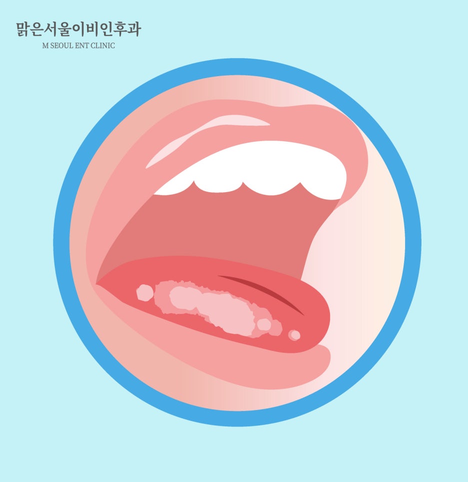 구내염 빨리 낫는 법은 [의정부이비인후과]