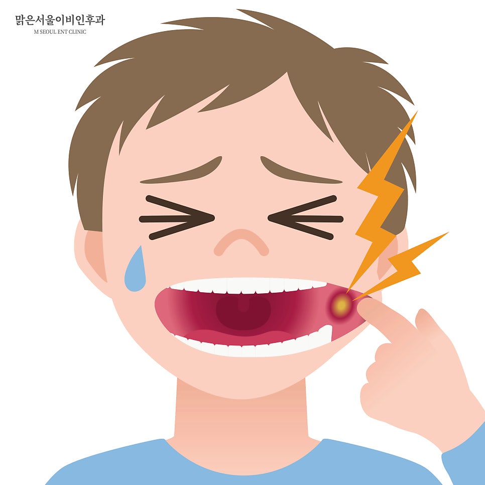 구내염 치료하려면? [노원이비인후과]