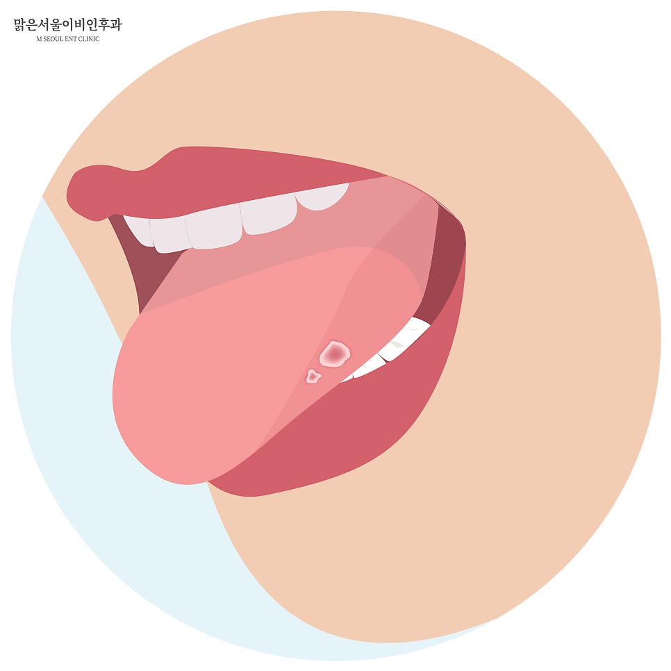 구내염 치료하려면? [노원이비인후과]