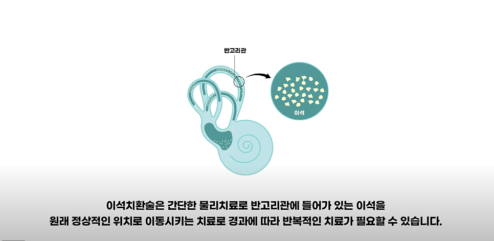 의정부 이비인후과 이석치환술 어떻게 진행할까?