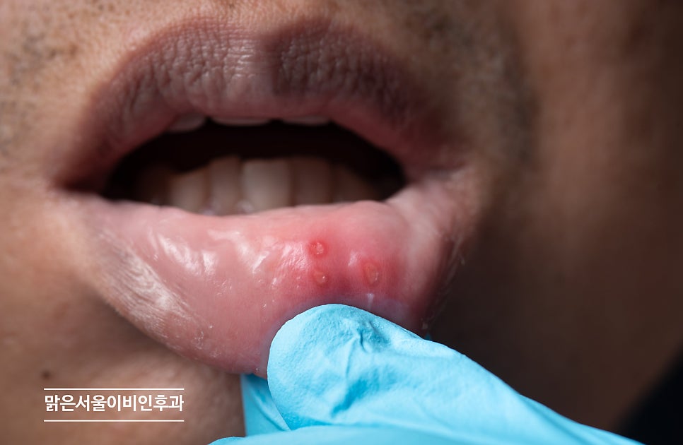 구내염은 어떻게 치료해야 할까요? [포천이비인후과]