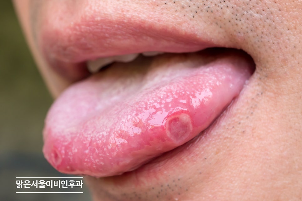 구내염은 어떻게 치료해야 할까요? [포천이비인후과]