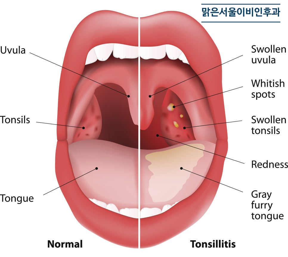 편도질환의 원인은? [양주이비인후과]
