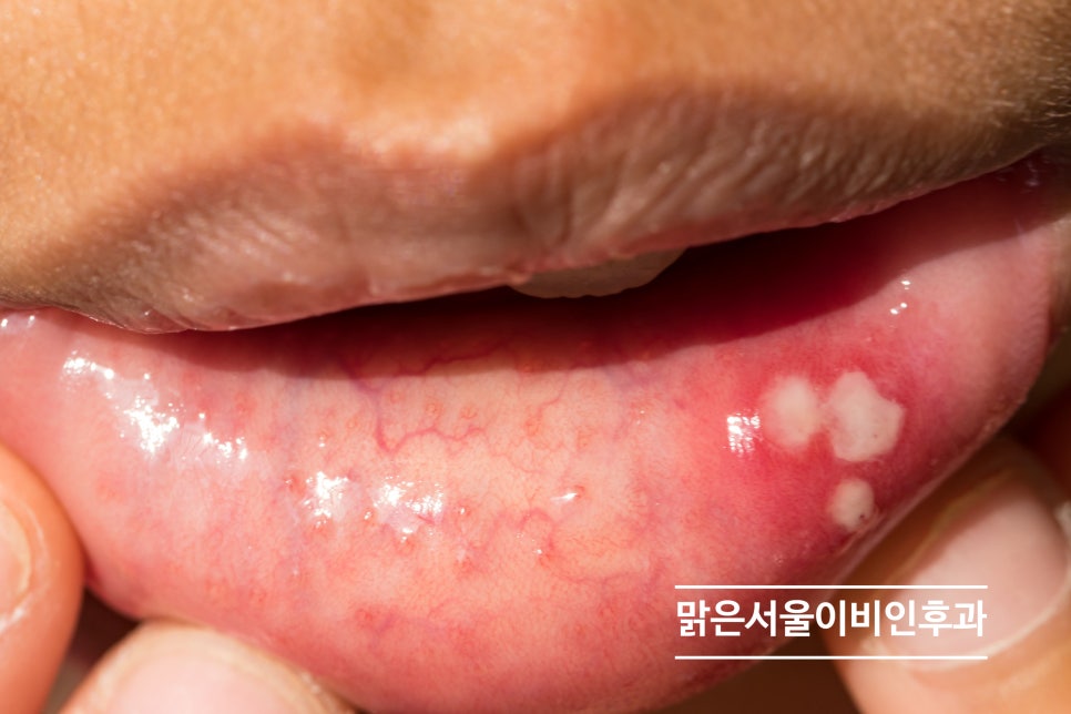 여름에 심해지는 구내염! [남양주이비인후과]