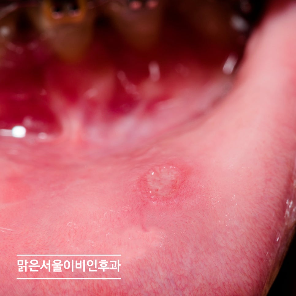 여름에 심해지는 구내염! [남양주이비인후과]