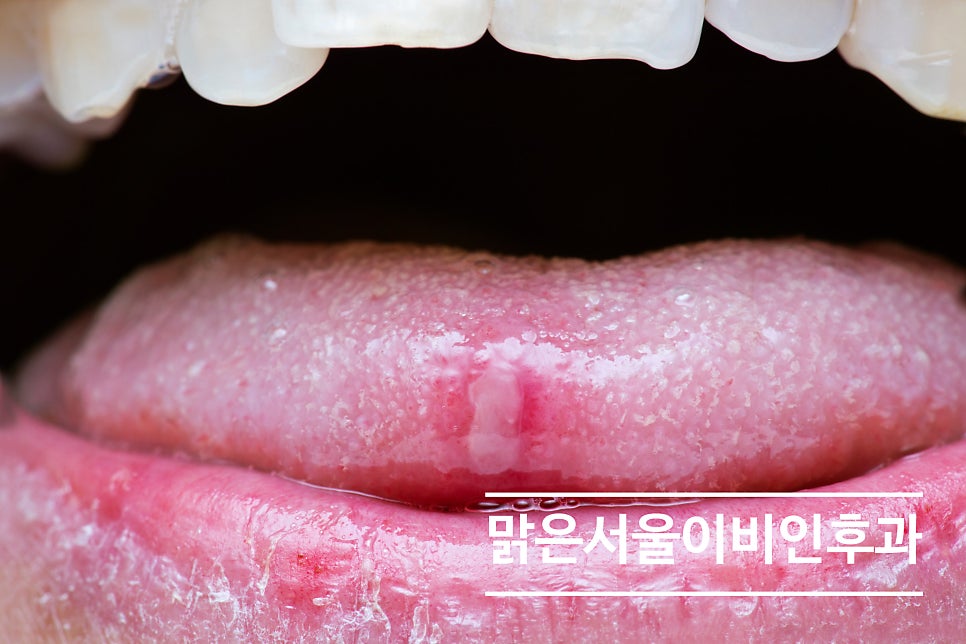 여름에 심해지는 구내염! [남양주이비인후과]