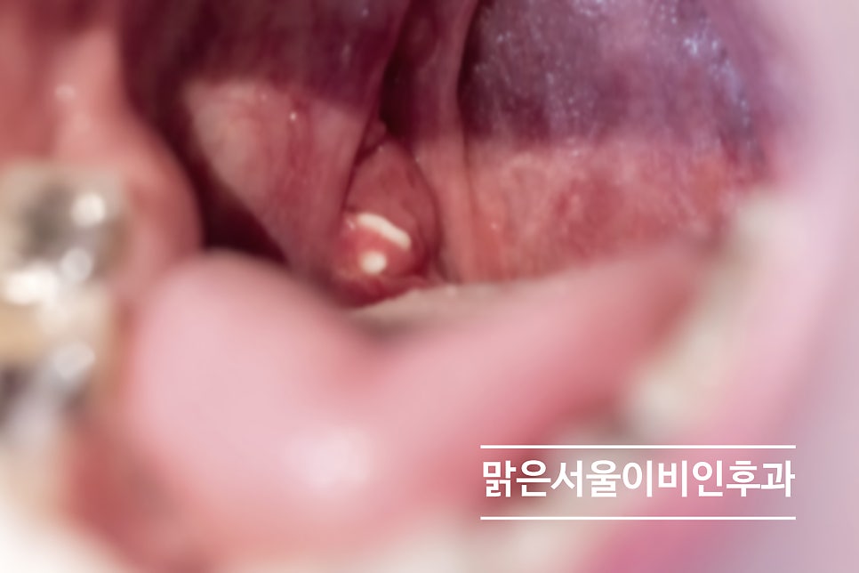 편도 결석이 무엇인가요? [연천이비인후과]