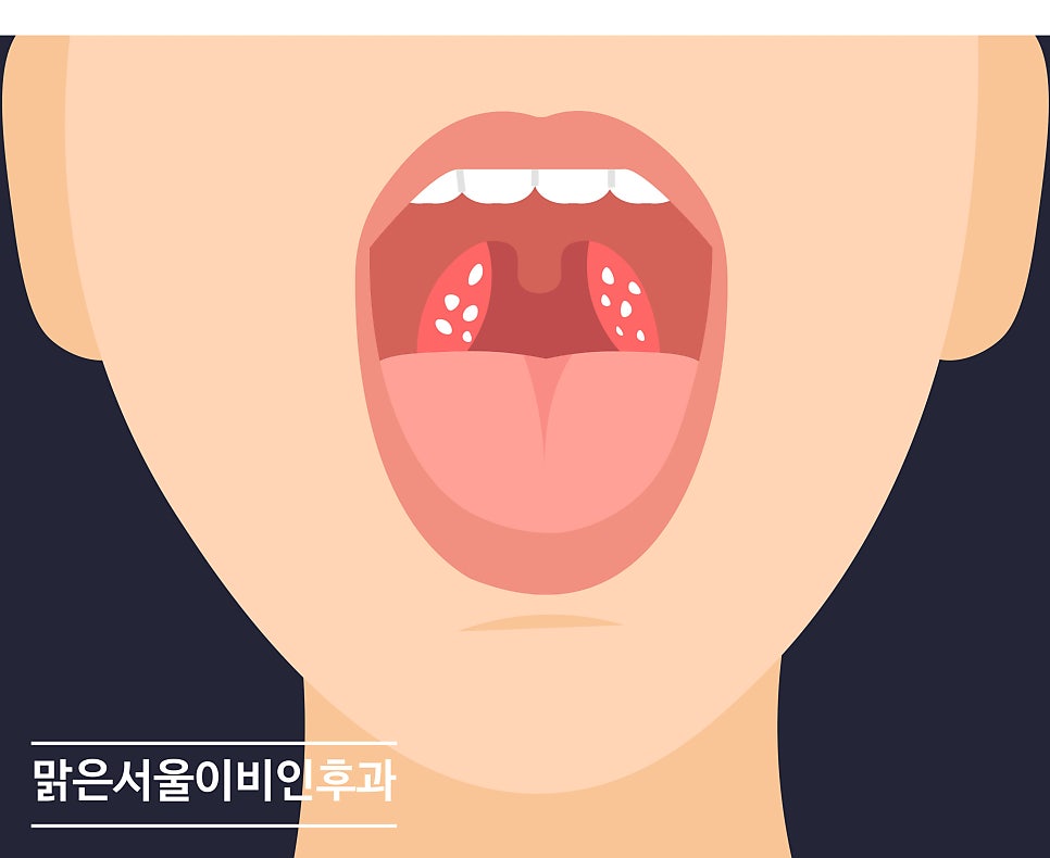 편도 결석이 무엇인가요? [연천이비인후과]