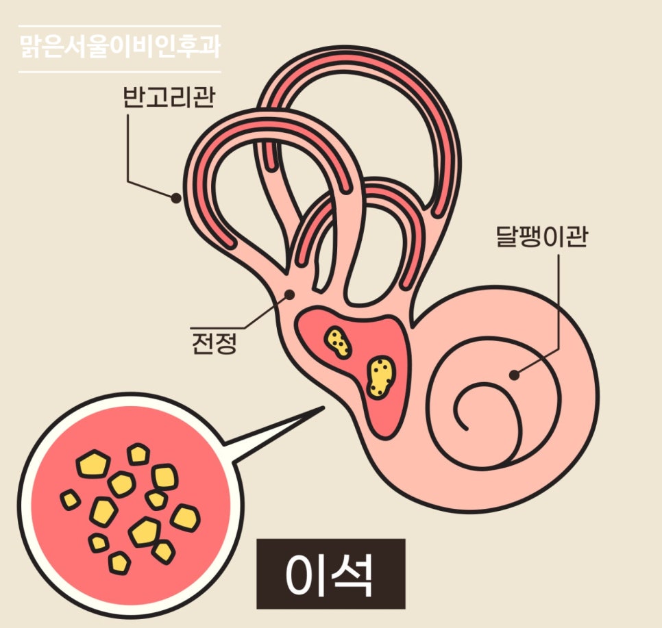 이석치환술은 어떻게 치료할까? [민락동이비인후과]