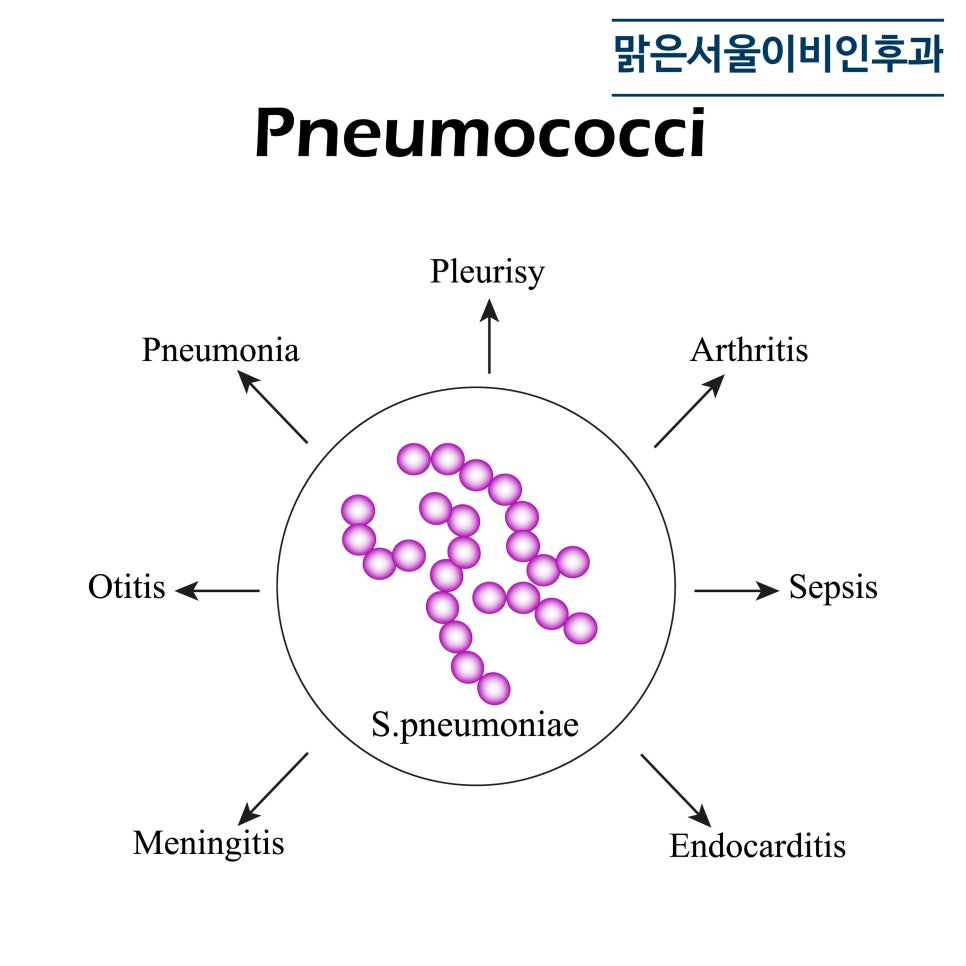 삼출성 중이염의 원인과 치료법은? [의정부역이비인후과]