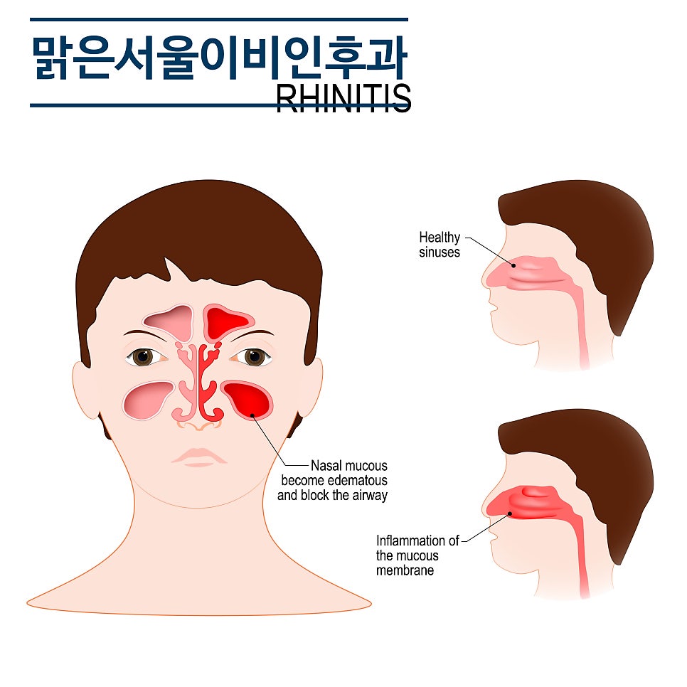 알레르기성 비염 어떻게 치료할까요? [양주이비인후과]
