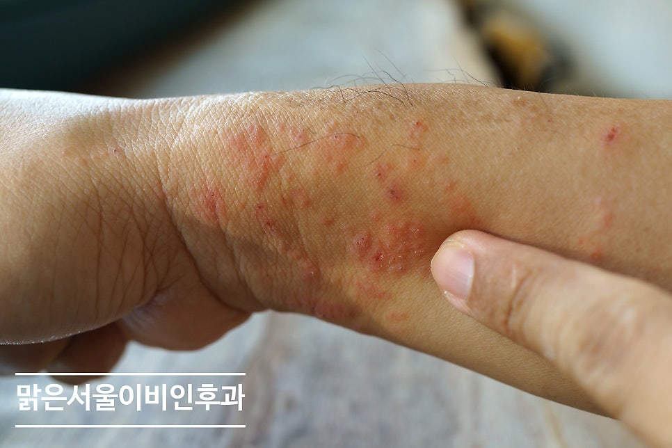 알레르기 검사 어떻게 진행할까요? [하남이비인후과]