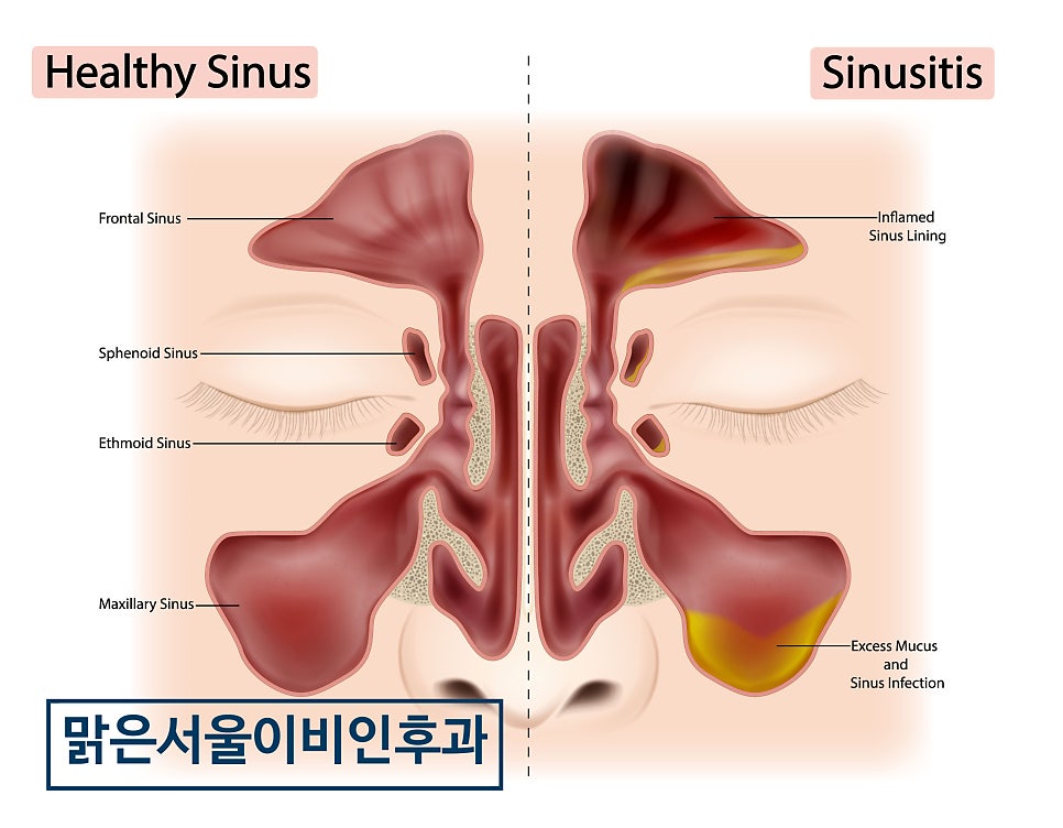 일교차가 큰 환절기에는 부비동염에 주의해주세요 [의정부이비인후과]