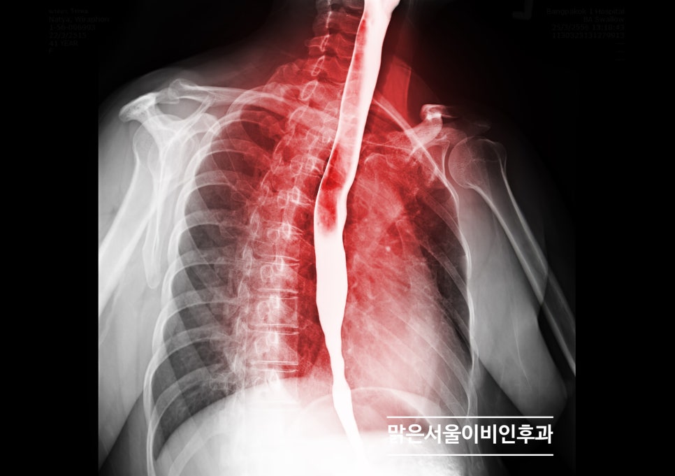 목이 건조하고 마른 느낌이 든다면? [연천이비인후과]