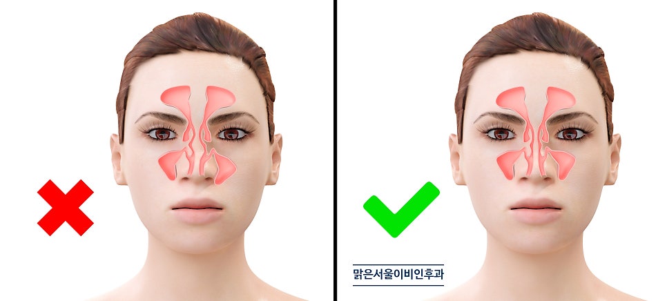 숨쉬기가 힘들다면 비중격만곡증을 의심해 보아야 합니다 [의정부이비인후과]