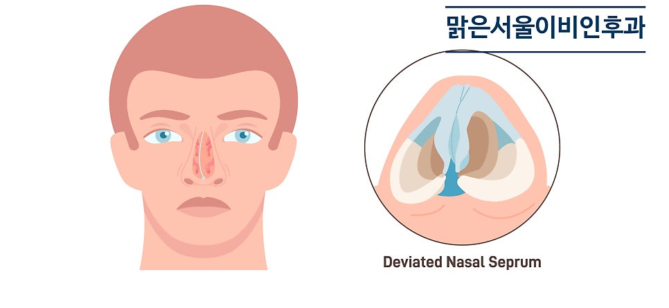 숨쉬기가 힘들다면 비중격만곡증을 의심해 보아야 합니다 [의정부이비인후과]