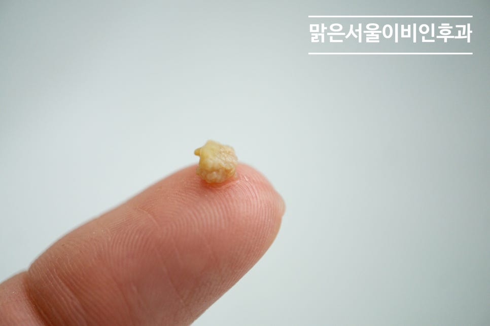 편도결석은 왜 생길까요? [진접이비인후과]
