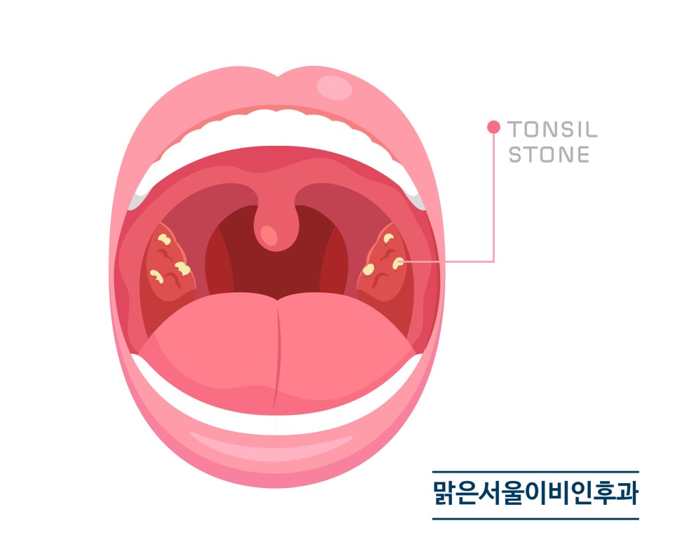 편도결석은 왜 생길까요? [진접이비인후과]
