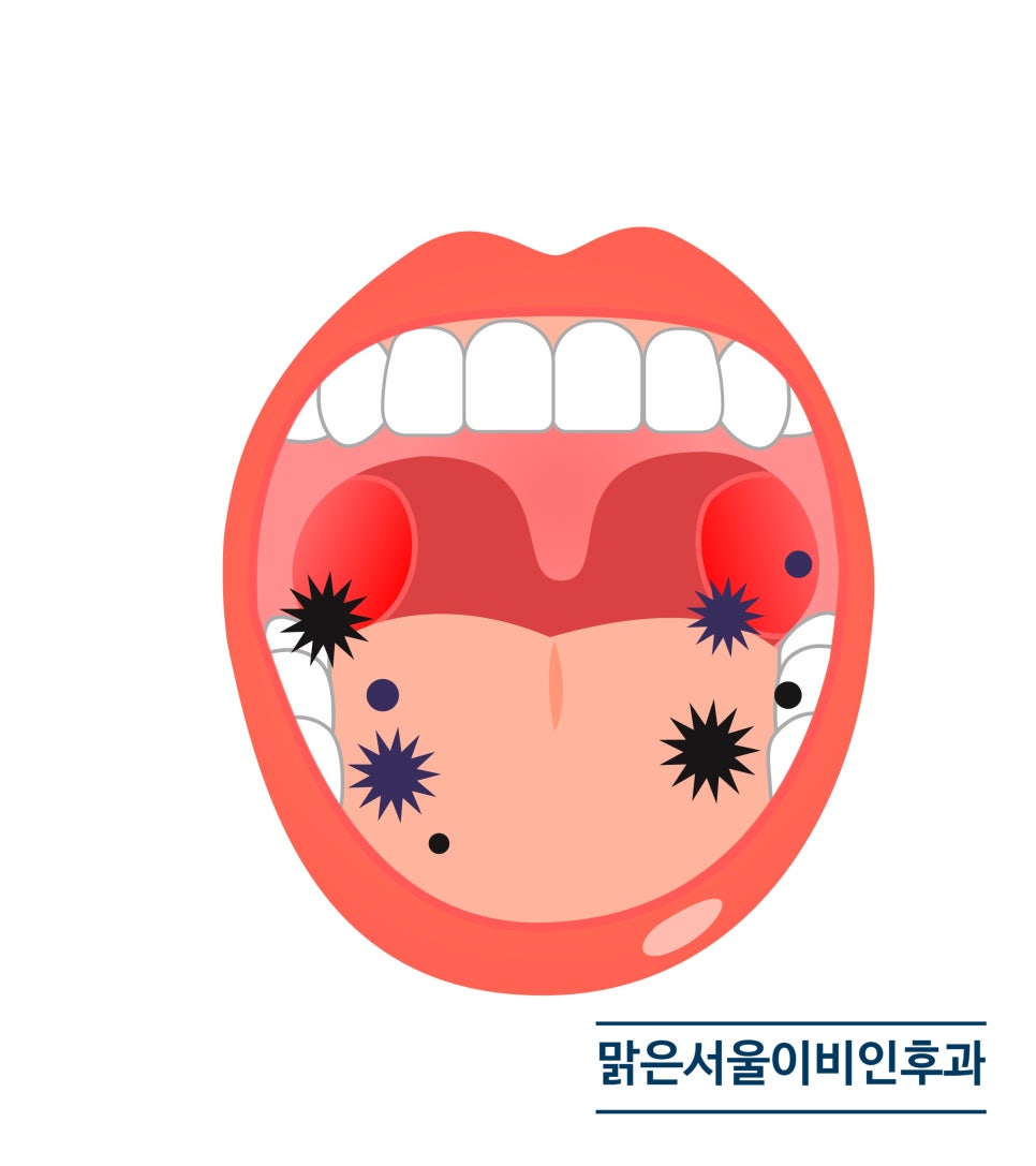 편도결석은 왜 생길까요? [진접이비인후과]