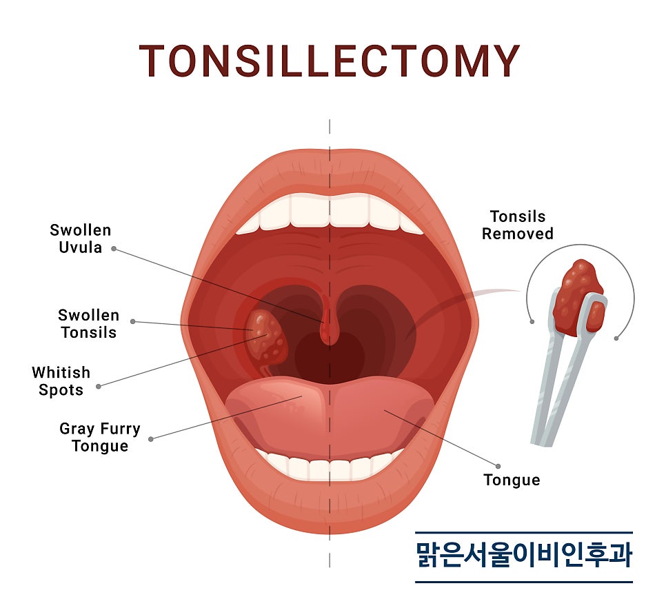 편도결석은 왜 생길까요? [진접이비인후과]
