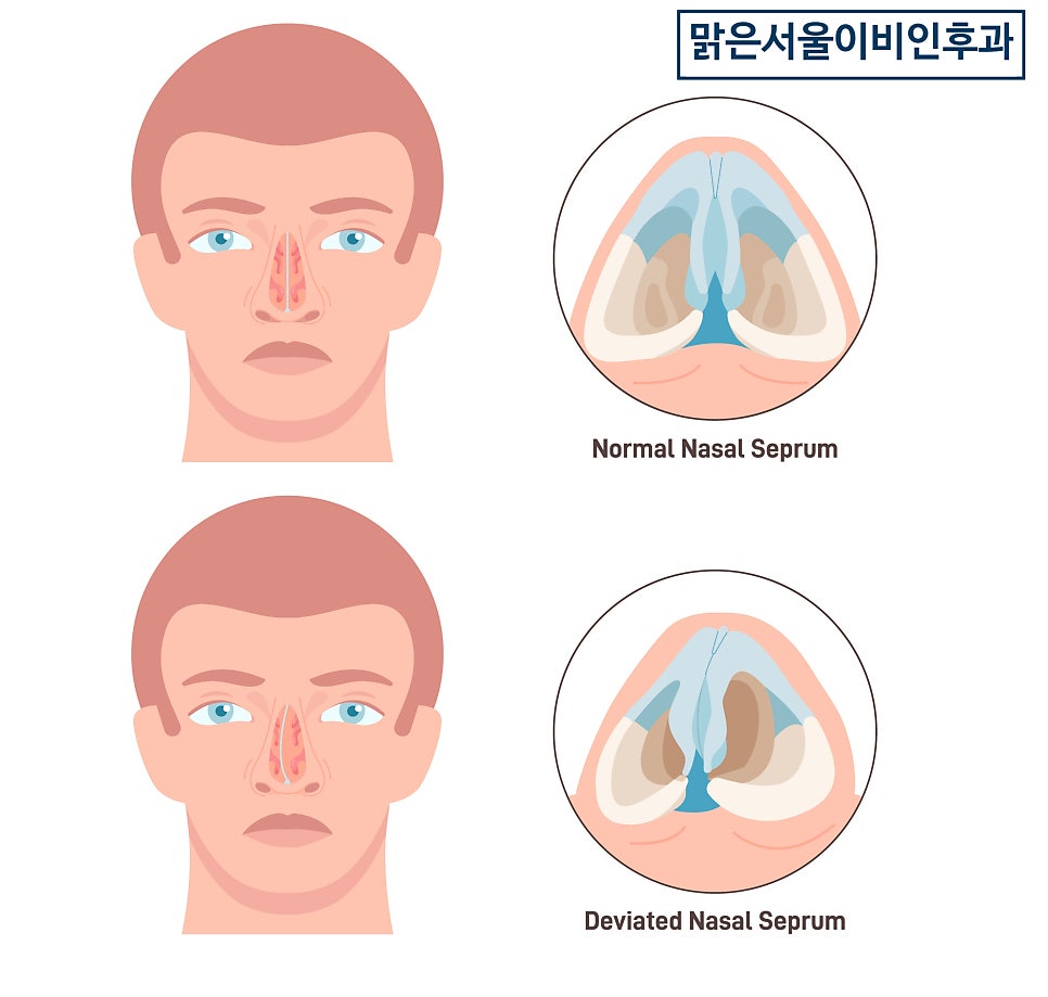 비밸브재건술은 왜 필요할까요? [하남이비인후과]