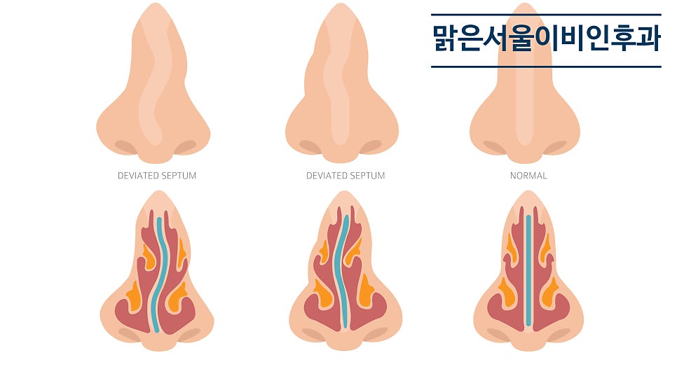 [의정부비염] 비염수술이 필요한 경우는?