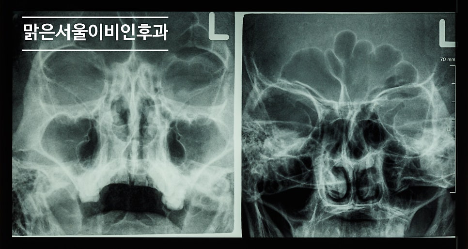 [의정부비염] 비염수술이 필요한 경우는?
