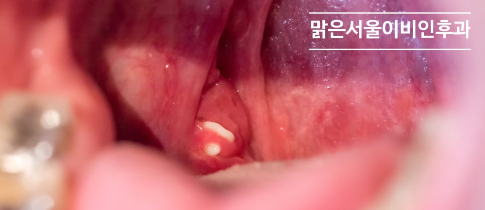 [의정부 편도결석] 양치를 해도 입 냄새가 심하다면?