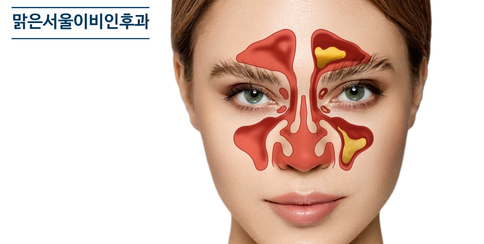 [민락동 이비인후과] 부비동염의 원인과 증상은?