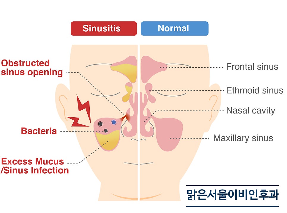 [별내이비인후과] 환절기에 감기에 쉽게 걸리는 이유는?