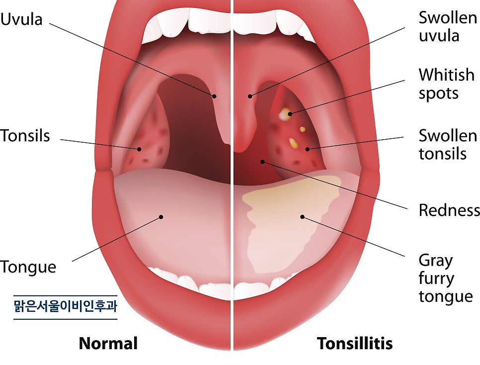 [구리이비인후과] 봄철 주의해야 할 편도선염!
