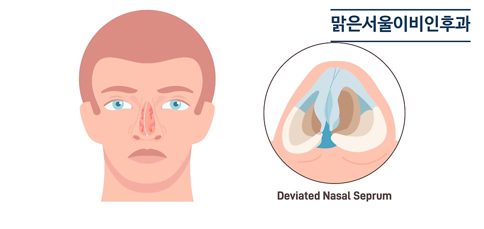 [의정부 비중격만곡증수술] 비중격만곡증수술의 효과는?
