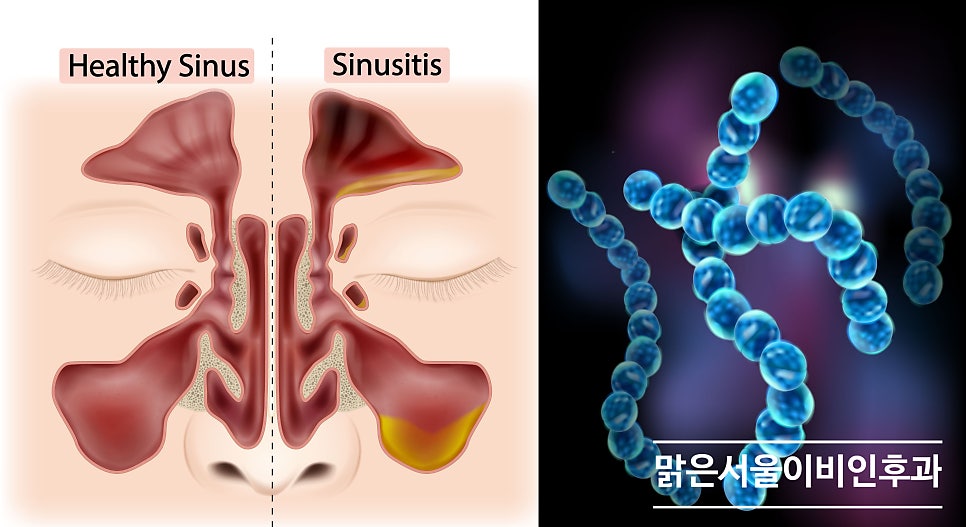 [의정부 비중격만곡증수술] 비중격만곡증수술의 효과는?