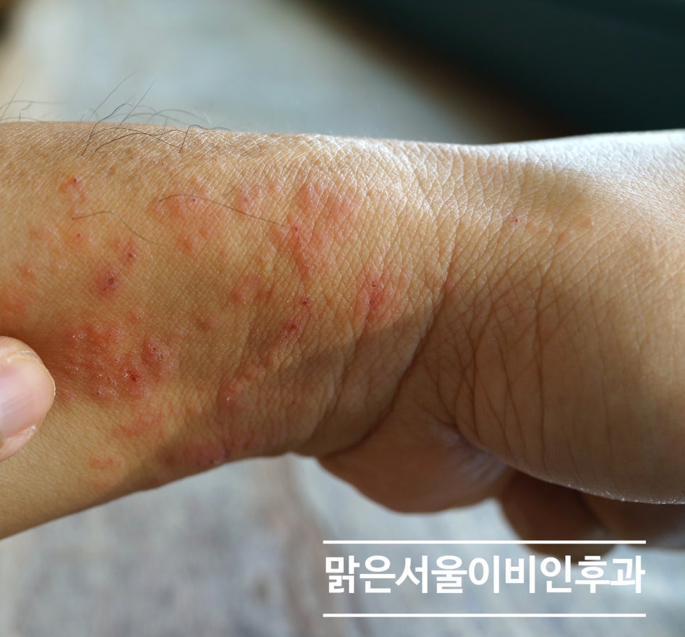 [의정부 햇빛알레르기] 외출만 하면 간지러우신가요? 햇빛알레르기 일 수도 있습니다