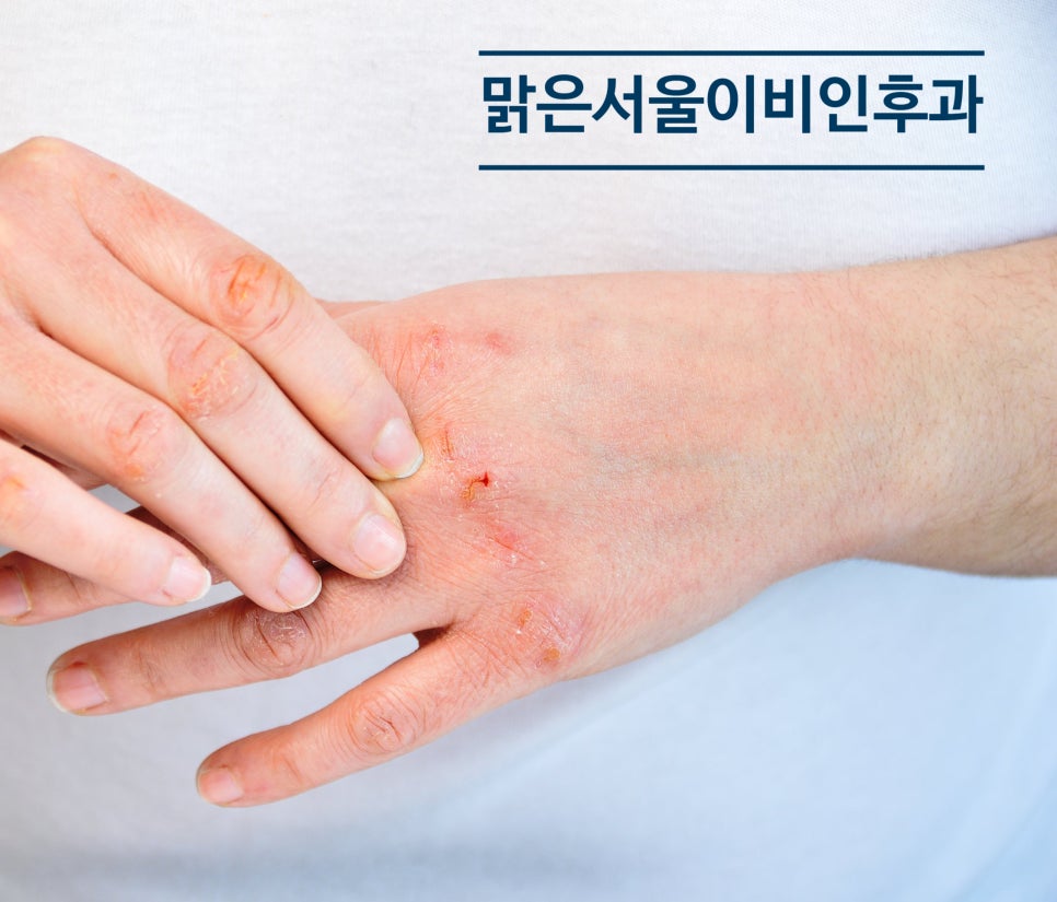 [의정부 햇빛알레르기] 외출만 하면 간지러우신가요? 햇빛알레르기 일 수도 있습니다